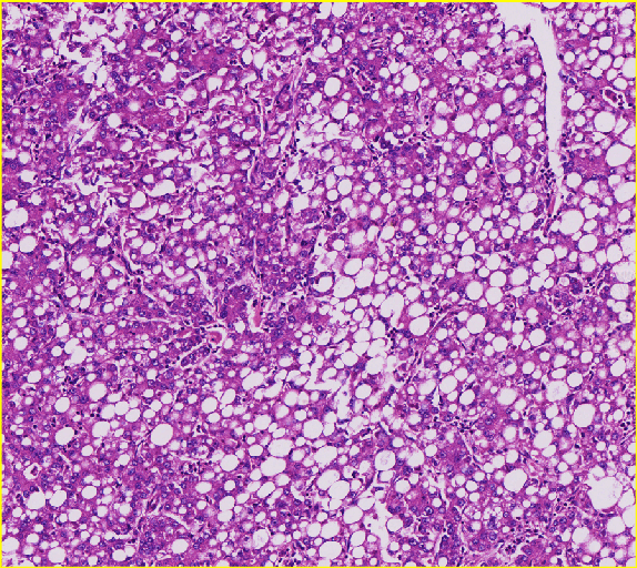 脂肪空泡分析-A