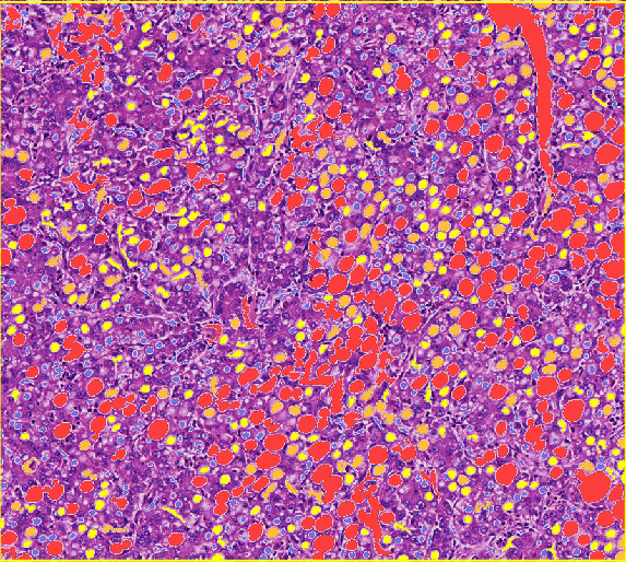 脂肪空泡分析-B